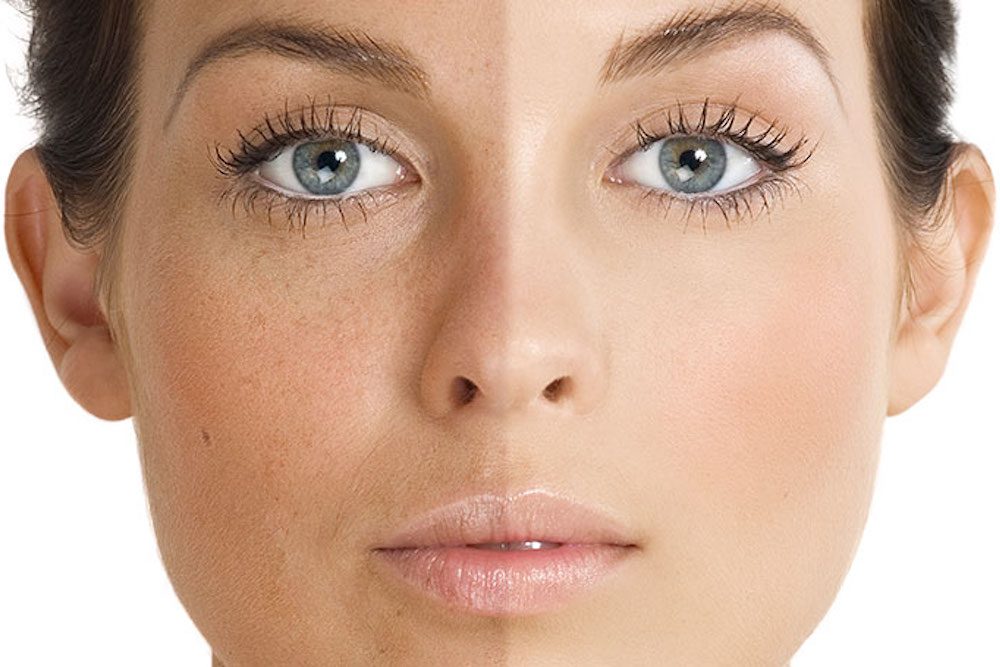 Uneven skin tone comparison showing photorejuvenation treatment area