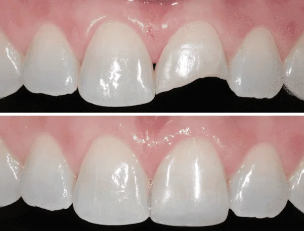 Aperfeiçoamento em Odontologia Estética