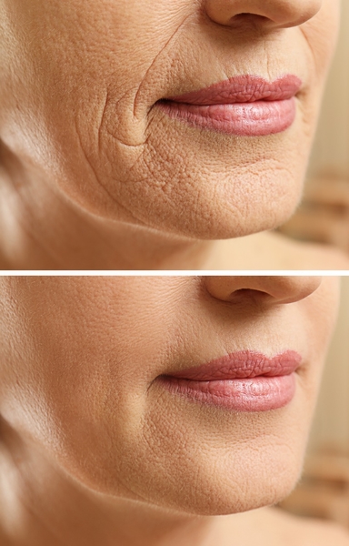 Harmonização Orofacial