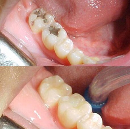 Imersão em Dentística e Prótese