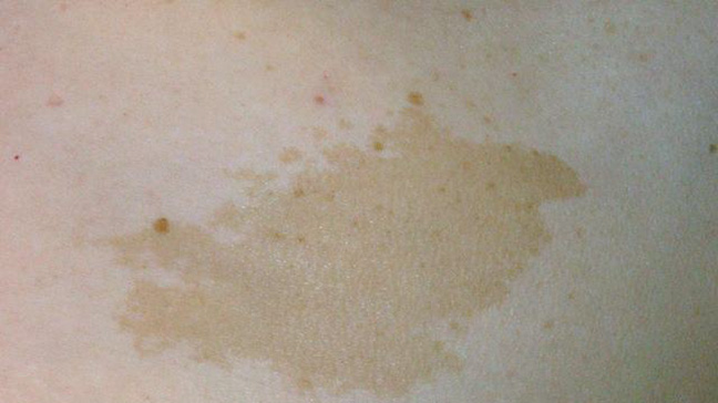 Café-au-lait birthmark patch on skin showing evenly pigmented flat mark