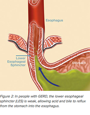 Medical diagram showing weak lower oesophageal sphincter allowing stomach acid to reflux upward