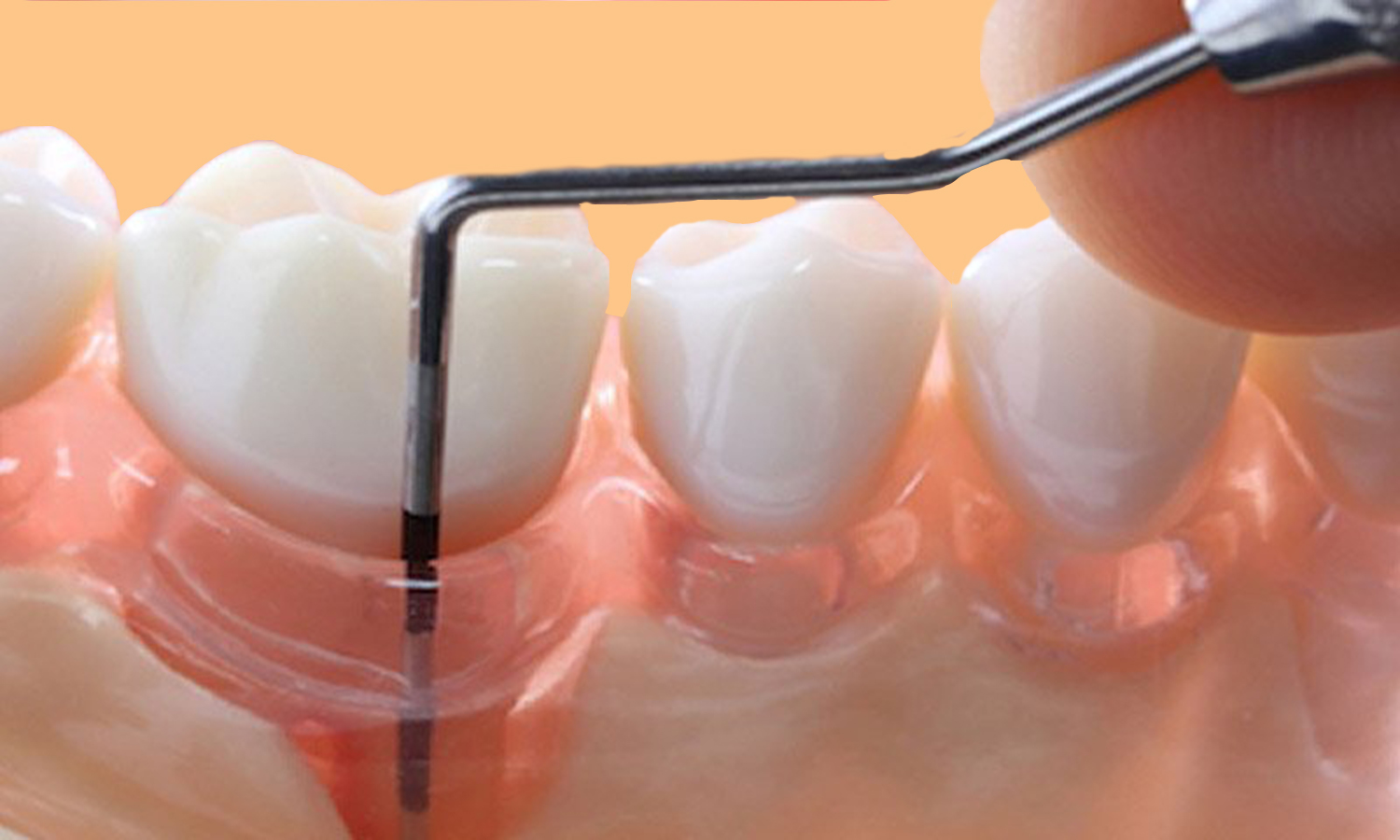Aperfeiçoamento em Periodontia