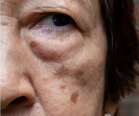 Close-up of solar lentigines and age spots on mature skin