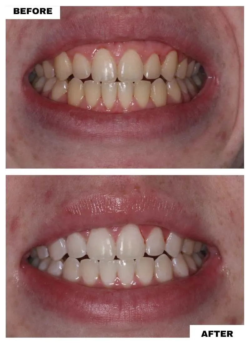 teeth whitening before after - Family Dentistry on Brock