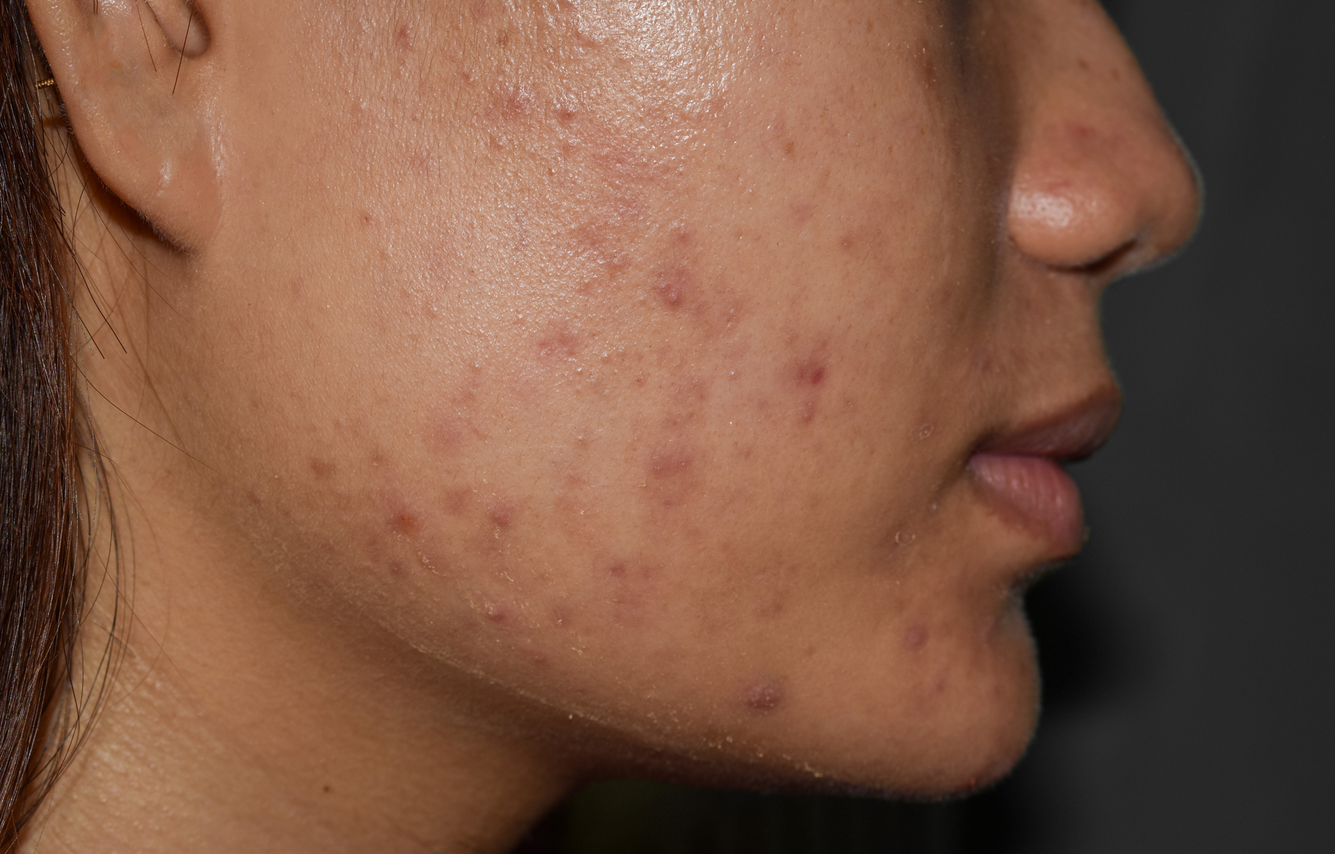 Post-inflammatory hyperpigmentation and acne marks on facial skin