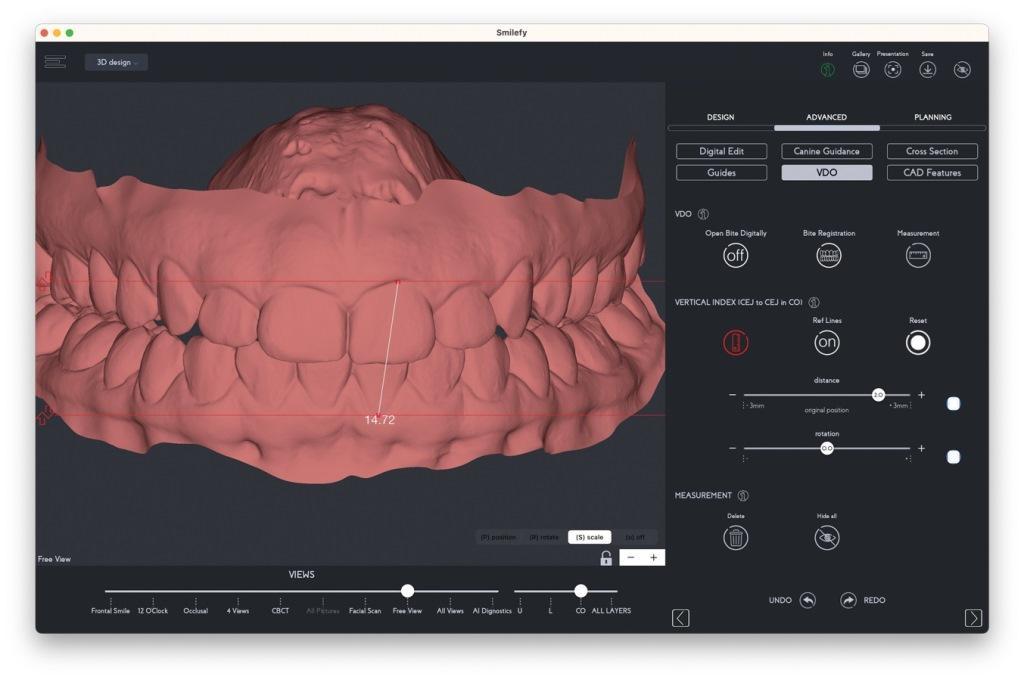 3D моделирование зубов в программе Smilefy