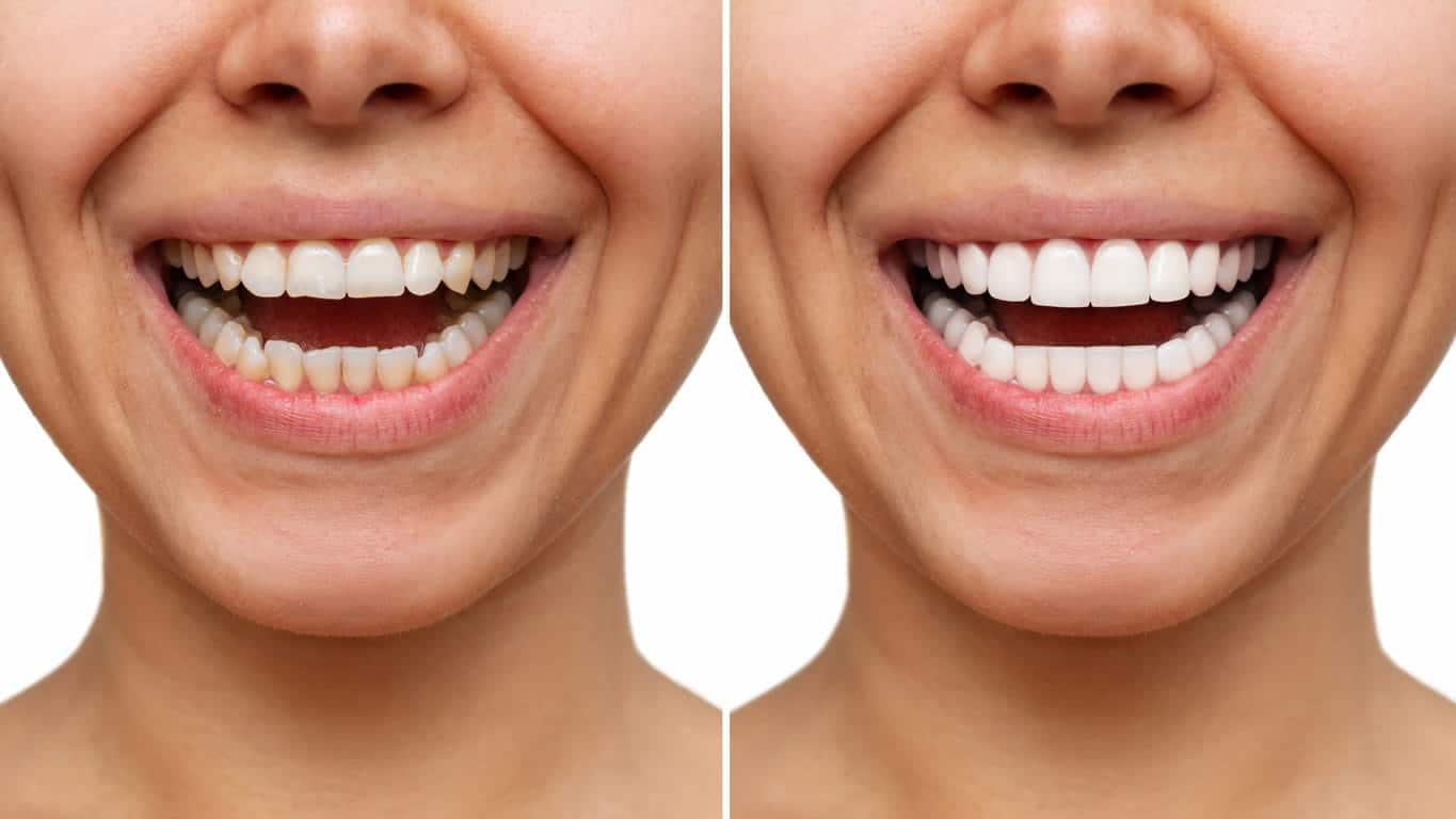 Before and After Teeth Whitening | Absolute Dental