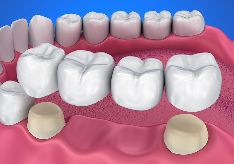 Prótese Dentária