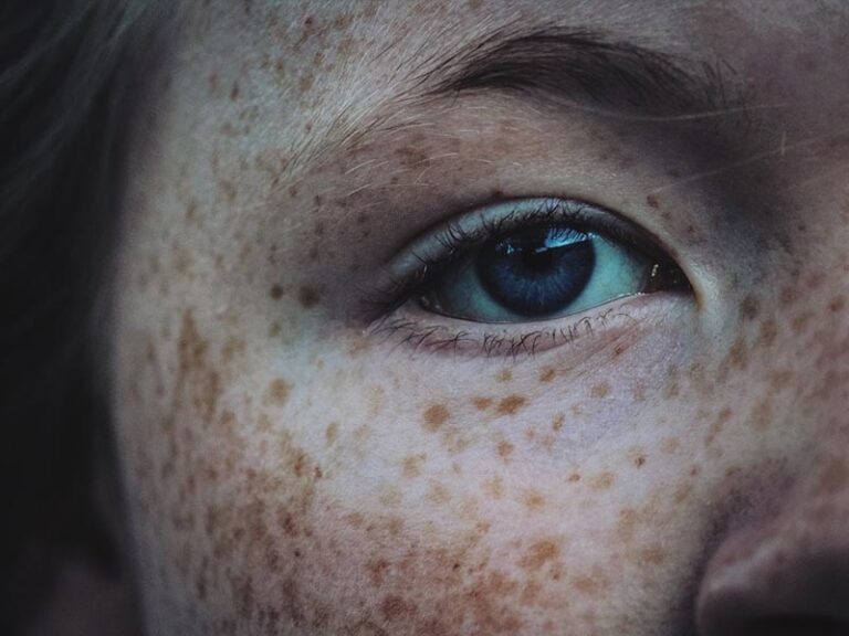 Freckles and solar lentigines concentrated on facial skin around the eye area
